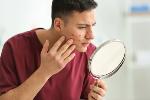 Porträtt Ung Man Med Akne Problem Tittar Spegeln Hemma — Stockfoto