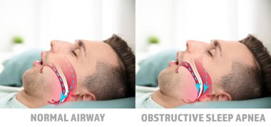 Illustrations showing difference between normal breathing and obstructive sleep apnea clipart