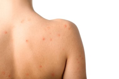 Beyaz arka plan üzerinde sivilce sorunu ile kız