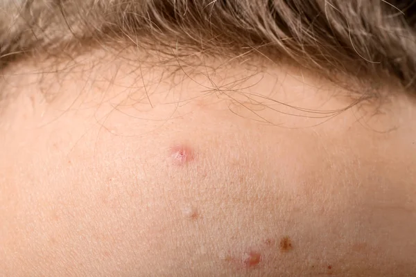 Adolescente Com Problema Acne Close — Fotografia de Stock