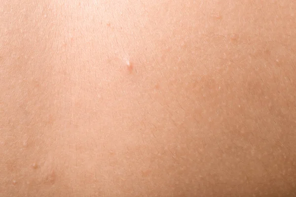 Human Skin Acne Closeup — Stock Photo, Image
