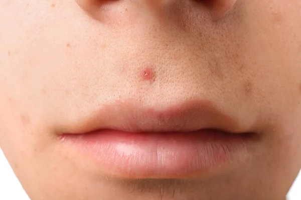 Teenager Acne Problem Closeup — Stock Photo, Image
