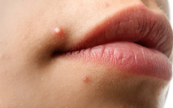 Young Woman Acne Problem Closeup — Stock Photo, Image