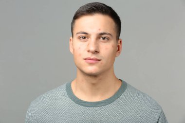 Gri arka plan üzerinde akne problemi olan genç adam portresi