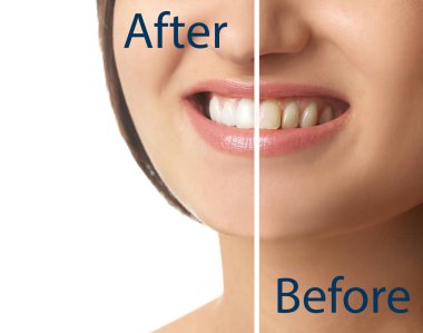 Güzel genç kadın diş beyazlatma, closeup önce ve sonra