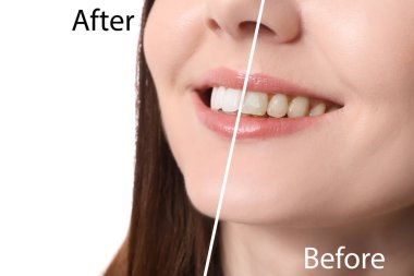 Güzel genç kadın diş beyazlatma, closeup önce ve sonra