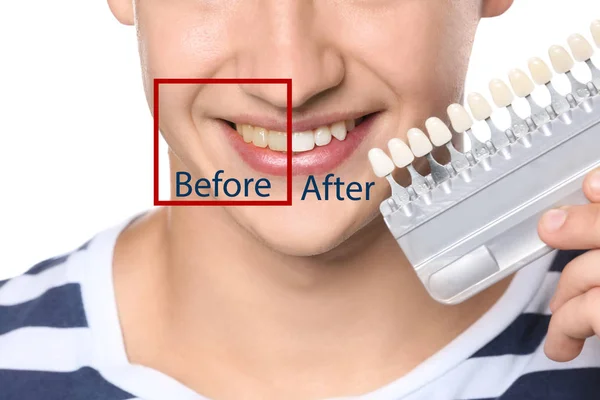 Handsome young man before and after teeth whitening, closeup — Stock Photo, Image