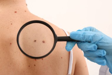 Dermatolog mol açık renkli, closeup hastaya incelenmesi