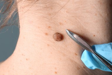 Doktor hastanın cilt, closeup köstebek kaldırmak mazgal gidiş ile