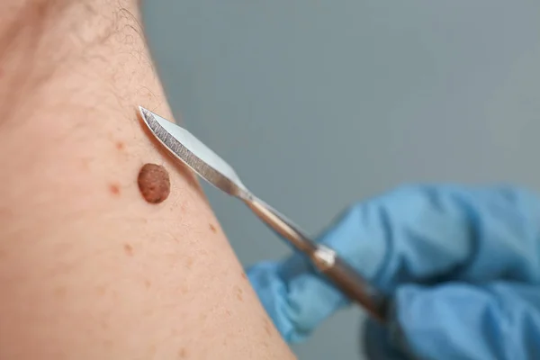 Doctor with lancet going to remove mole from patient's skin, closeup — Stock Photo, Image