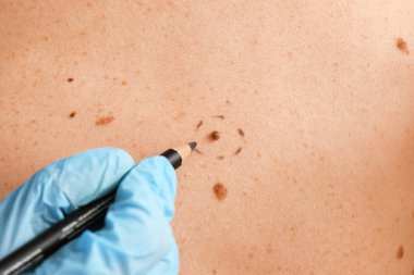 Dermatolog mol kaldırma, closeup önce hastanın cilt üzerine işaretleri uygulama