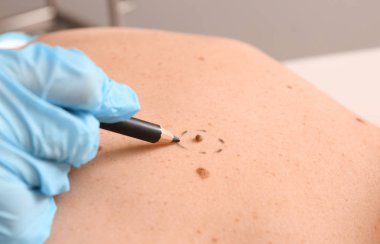 Dermatolog mol kaldırma, closeup önce hastanın cilt üzerine işaretleri uygulama
