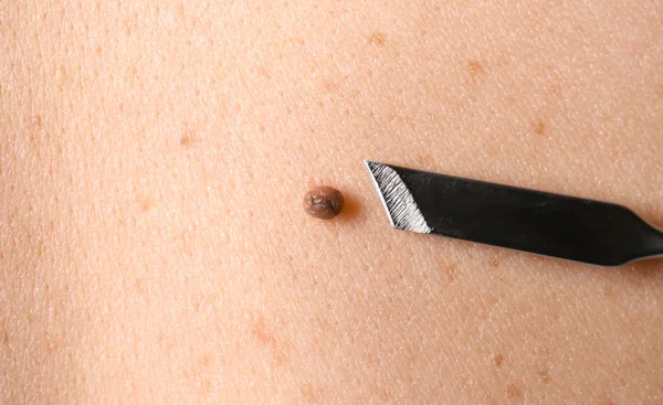 Lanzette in der Nähe von Maulwurf auf menschlicher Haut, Nahaufnahme — Stockfoto
