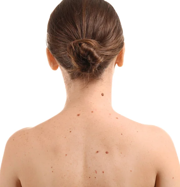 Young woman with moles on white background — Stock Photo, Image