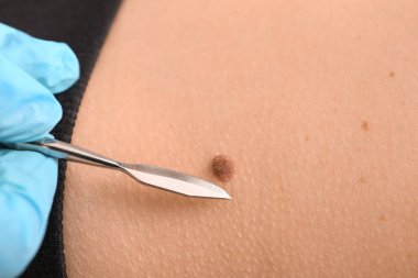 Doktor hastanın cilt, closeup köstebek kaldırmak mazgal gidiş ile
