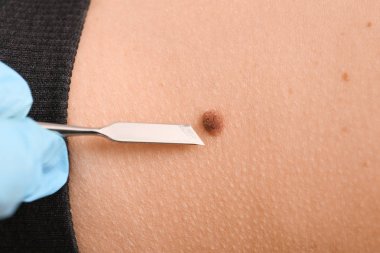 Doktor hastanın cilt, closeup köstebek kaldırmak mazgal gidiş ile