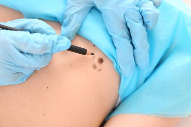 Dermatolog mol kaldırma, closeup önce hastanın cilt üzerine işaretleri uygulama