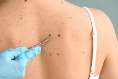 Doktor hastanın cilt, closeup köstebek kaldırmak mazgal gidiş ile