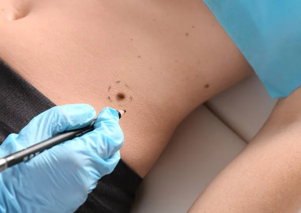 Dermatologist applying marks onto patient's skin before moles removal — Stock Photo, Image