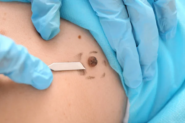 Läkare med lansetten kommer att ta bort mullvad från patientens hud, närbild — Stockfoto