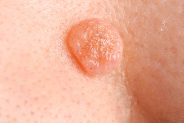 Menselijke huid met moedervlek, close-up — Stockfoto
