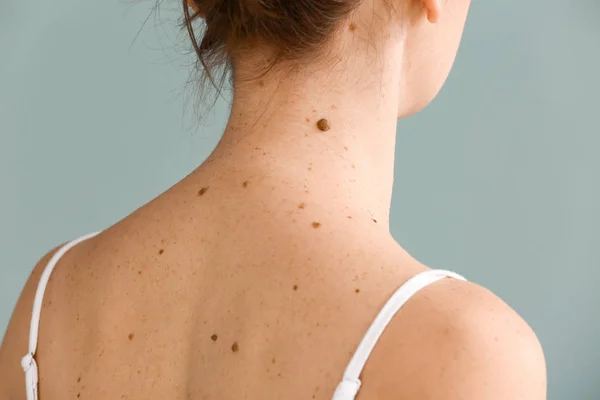 Young woman with moles on grey background — Stock Photo, Image