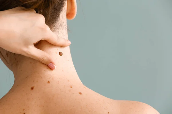 Dermatologo che esamina nei di paziente su sfondo grigio — Foto Stock