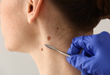 Doktor hastanın cilt, closeup köstebek kaldırmak mazgal gidiş ile