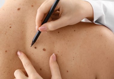 Dermatolog mol kaldırma, closeup önce hastanın cilt üzerine işaretleri uygulama