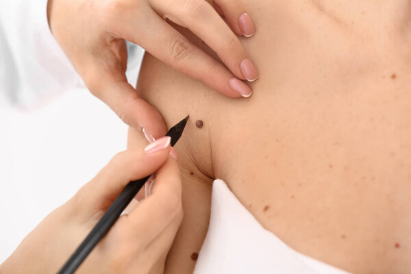 Dermatologist applying marks onto patient's skin before moles removal, closeup