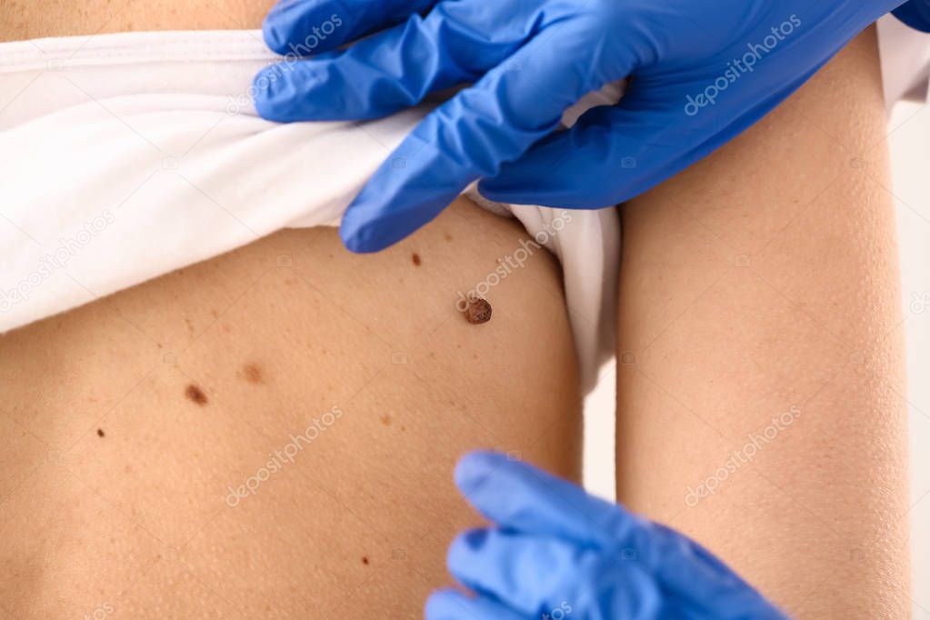 Dermatologist examining moles of patient, closeup