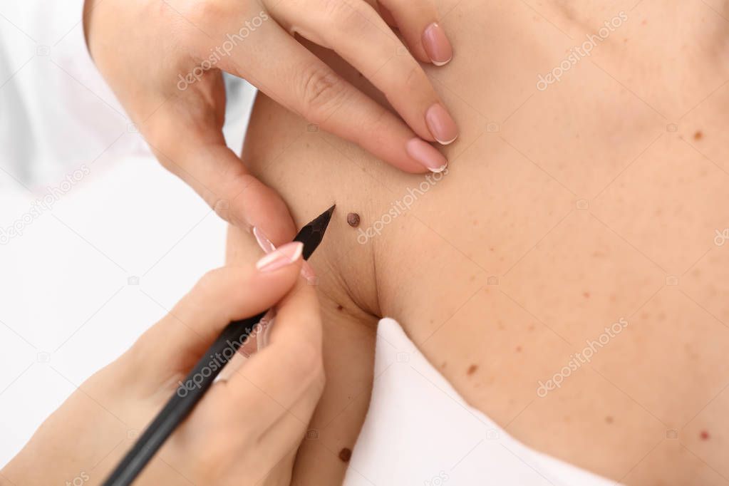 Dermatologist applying marks onto patient's skin before moles removal, closeup