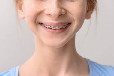 Gri arka planda diş telleri ile Gülümseyen genç kız