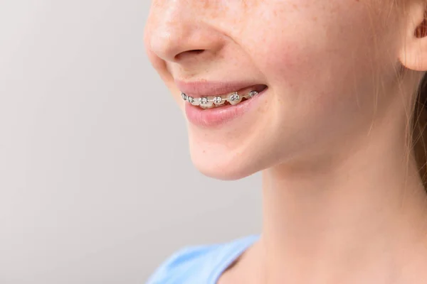 Sonriente adolescente con frenos dentales sobre fondo gris — Foto de Stock