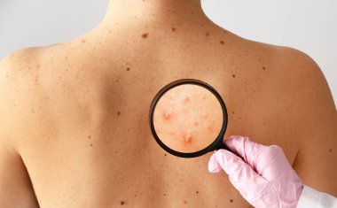 Dermatolog büyüteç ile akne sorunu olan genç kadının cilt bakıyor 