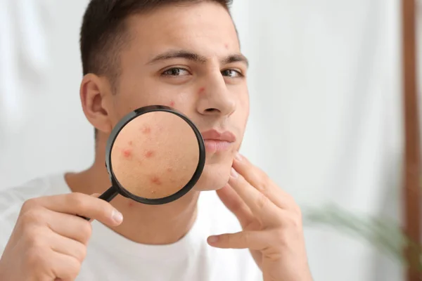 Retrato de jovem com problema de acne e lupa em casa — Fotografia de Stock