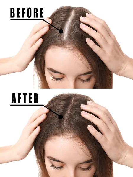 Mujer antes y después del tratamiento de pérdida de cabello sobre fondo blanco —  Fotos de Stock