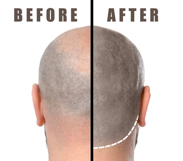Homem antes e depois do tratamento da perda de cabelo no fundo branco — Fotografia de Stock