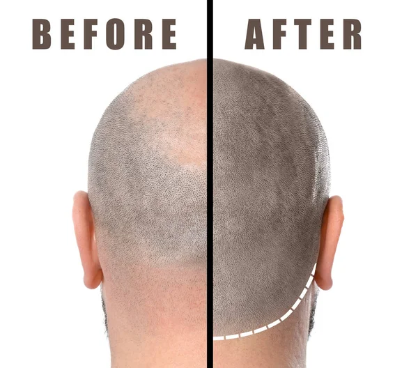 Man before and after hair loss treatment on white background — Stock Photo, Image