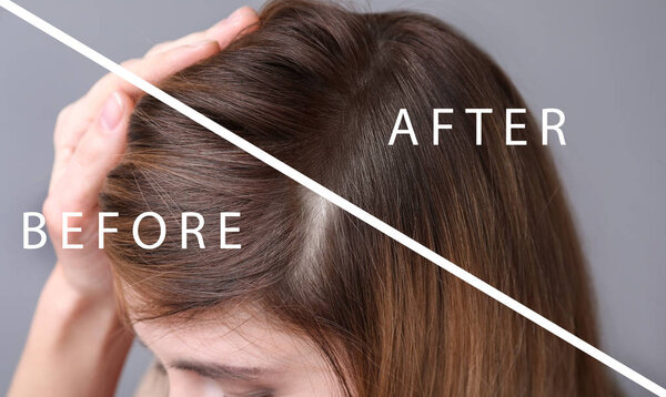 Woman before and after hair loss treatment on grey background