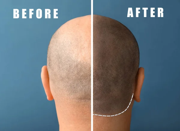 Hombre antes y después del tratamiento de pérdida de cabello en el fondo de color —  Fotos de Stock