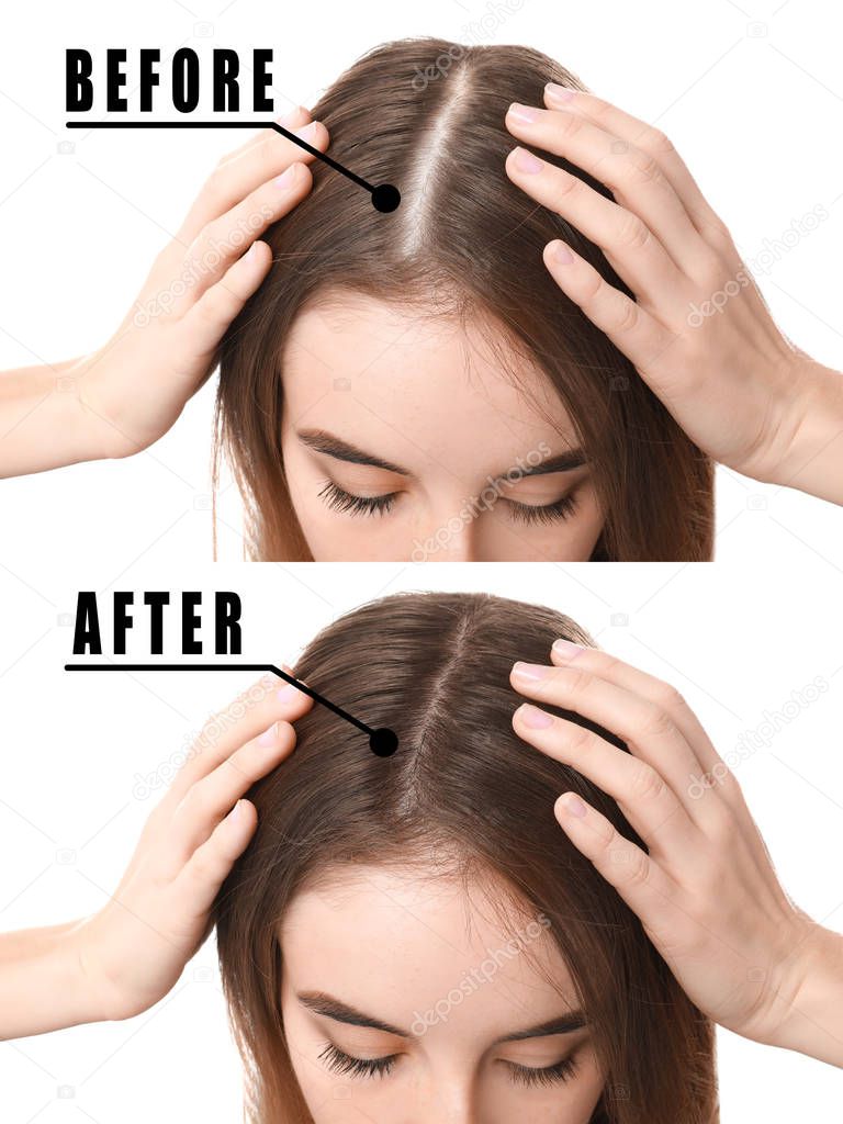 Woman before and after hair loss treatment on white background