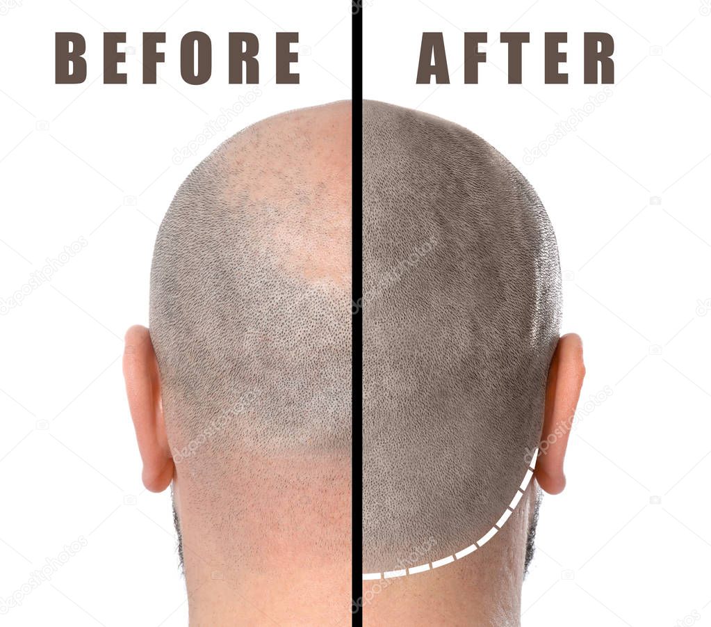 Man before and after hair loss treatment on white background