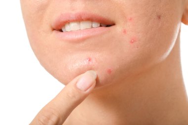 Beyaz arka planda akne sorunu olan genç kadın, closeup