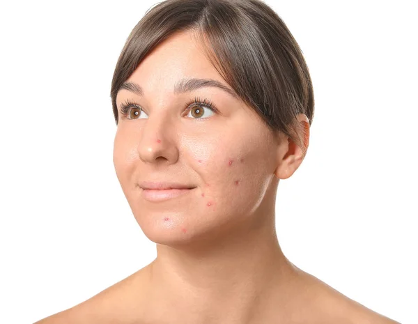 Mujer joven con problemas de acné sobre fondo blanco — Foto de Stock