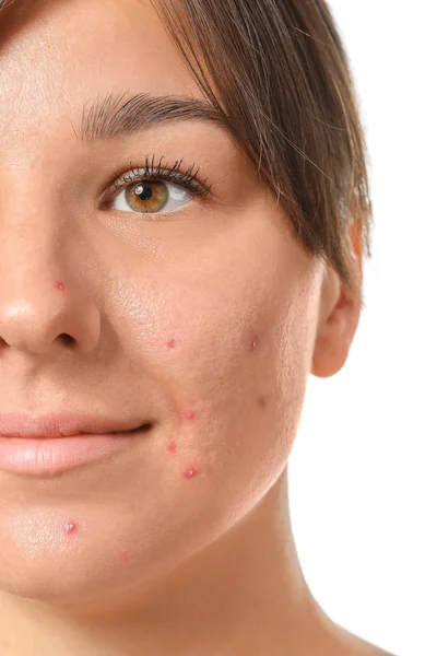 Young woman with acne problem on white background, closeup — Stock Photo, Image