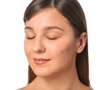 Beyaz arka planda sivilce sorunu olan genç bir kadın.