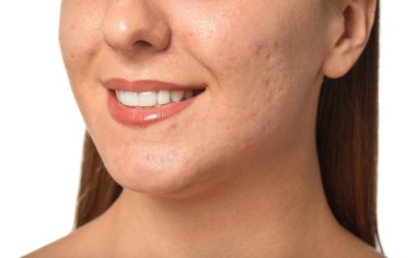 Beyaz arka planda akne sorunu olan genç kadın, closeup