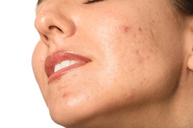 Beyaz arka planda akne sorunu olan genç kadın, closeup