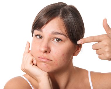 Beyaz arka planda sivilce sorunu olan genç bir kadın.